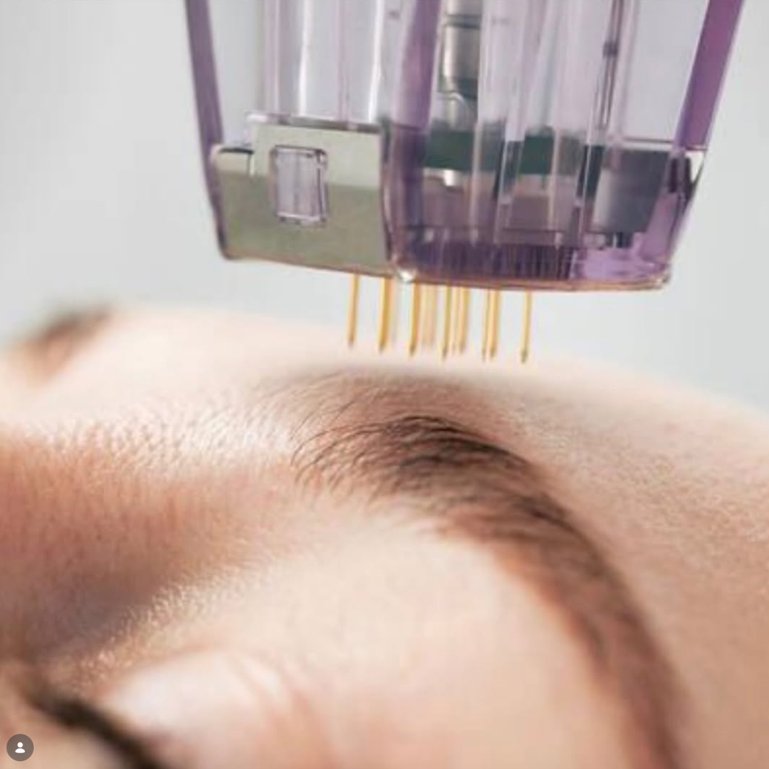 Medspa in Cheney, WA 99004 l Microneedling Near Me