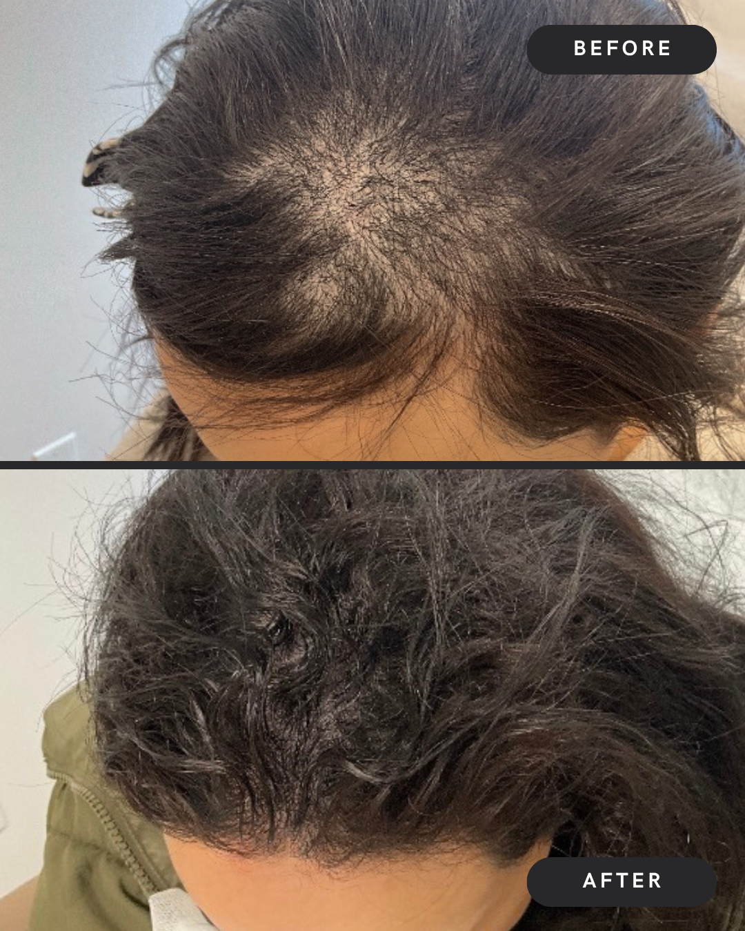 Hair Restoration