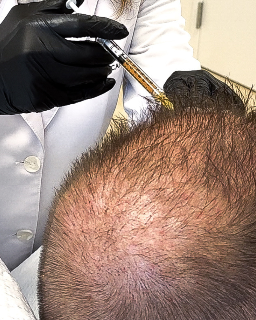 Hair Restoration