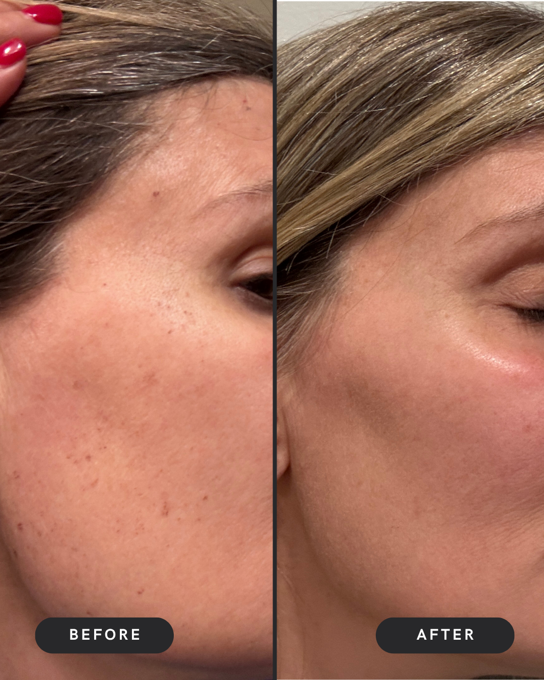 Brown Spots Removal