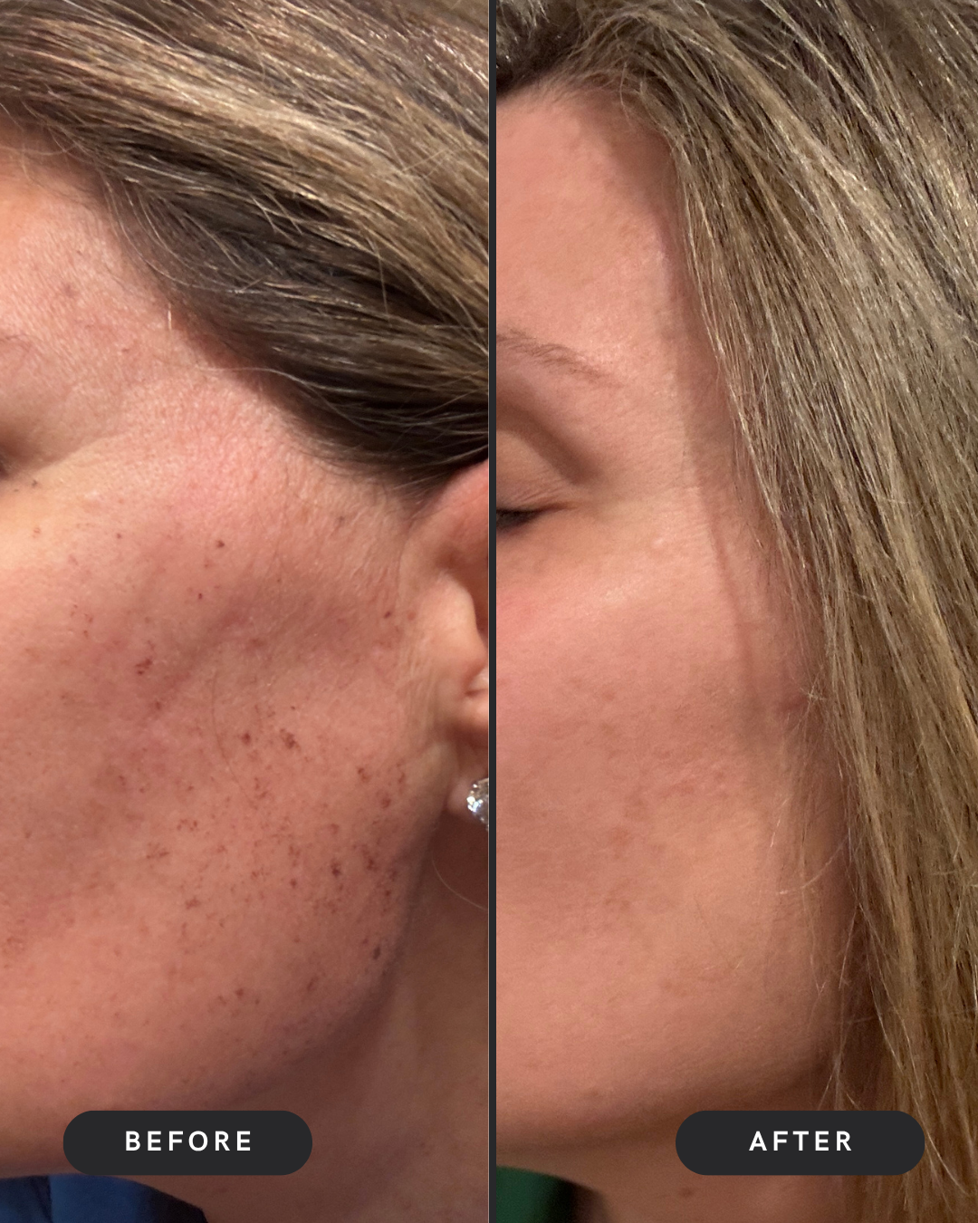 Brown Spots Removal