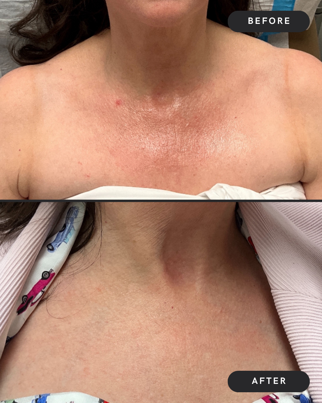 Redness Removal