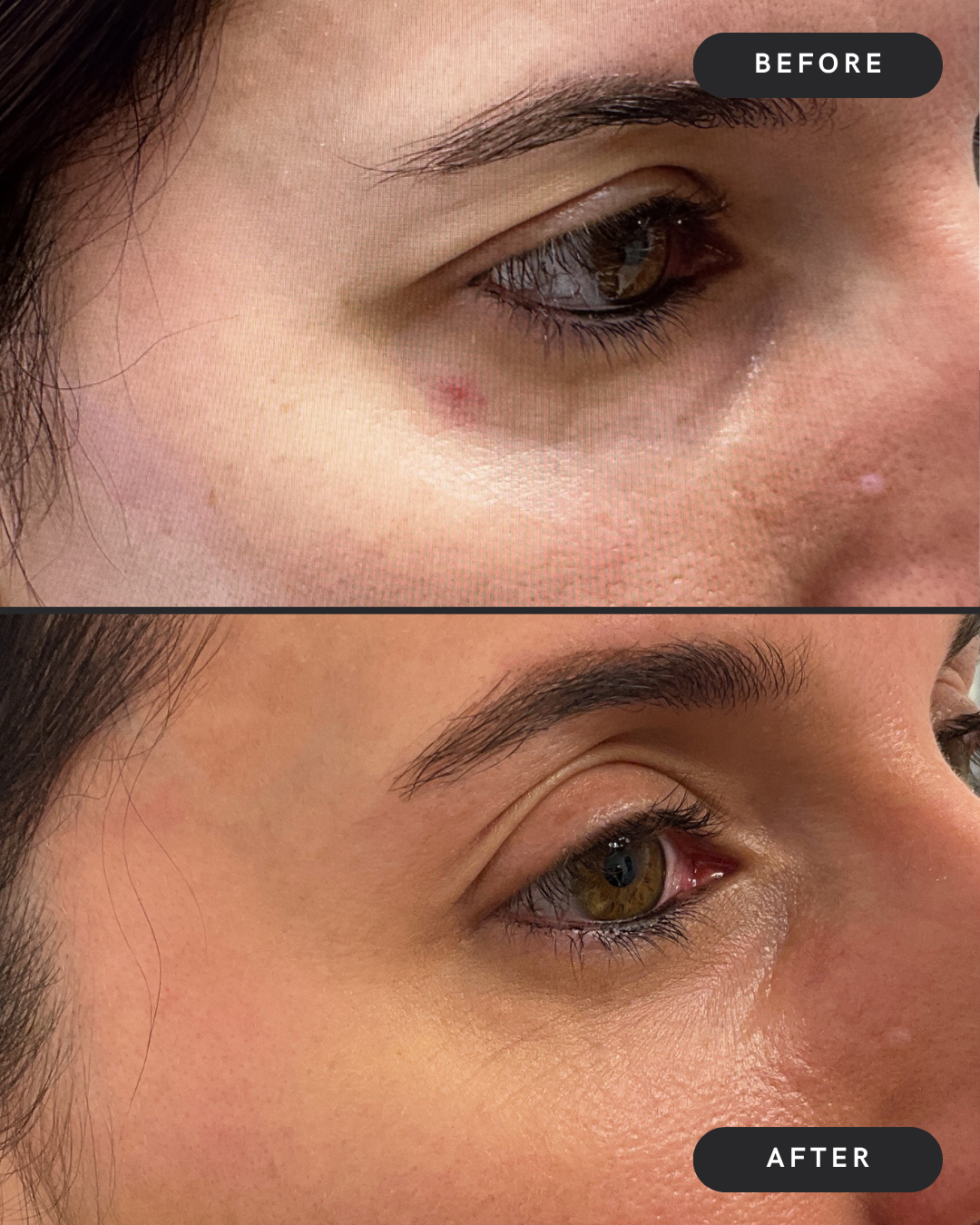 Cherry Angioma Removal