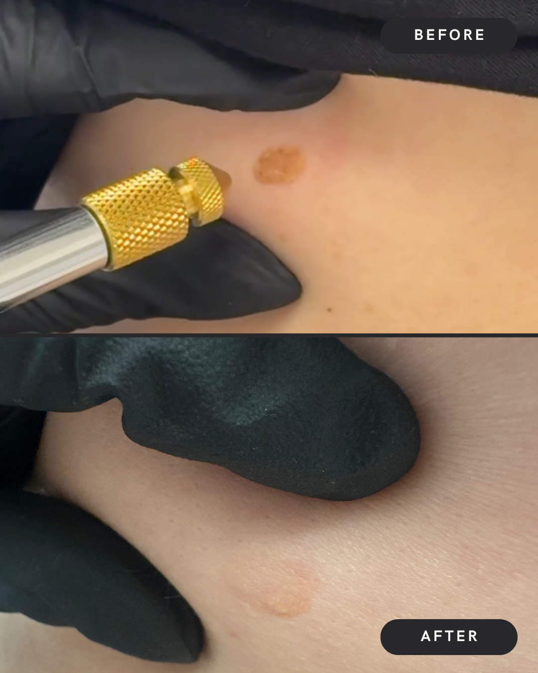 Skin Tag Removal