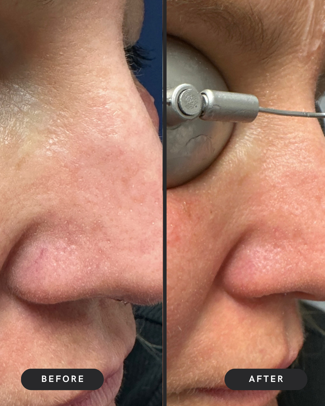 Broken Capillaries Removal