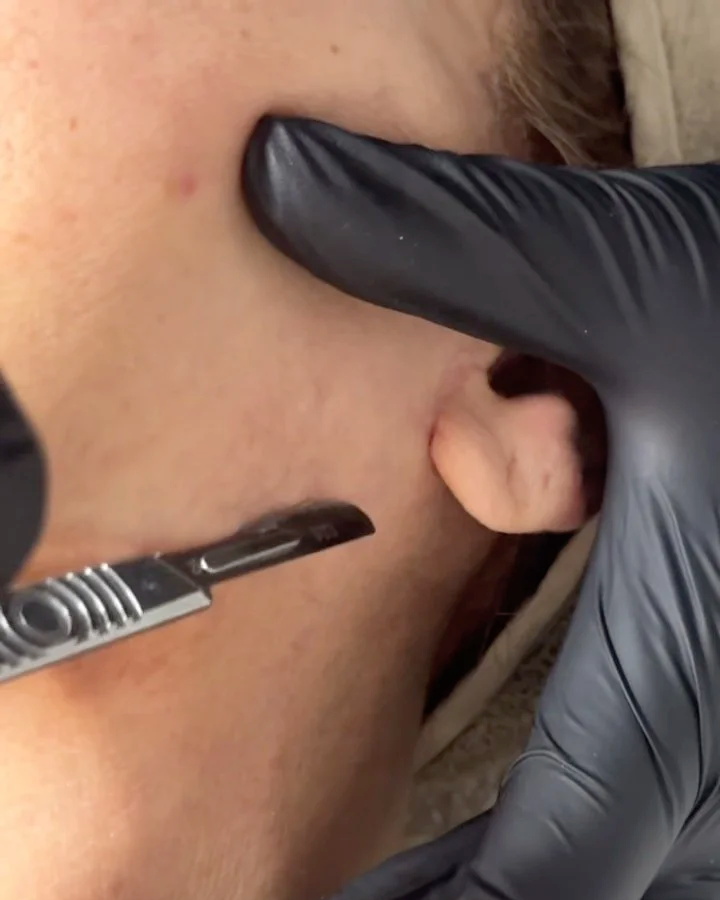 Dermaplane