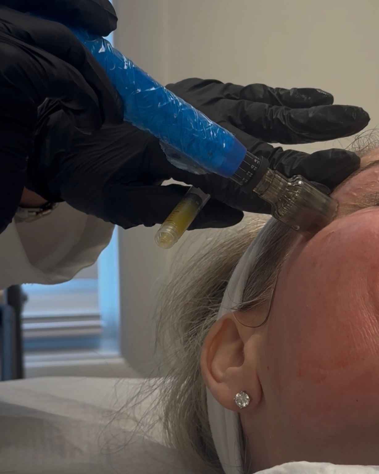 Microneedling