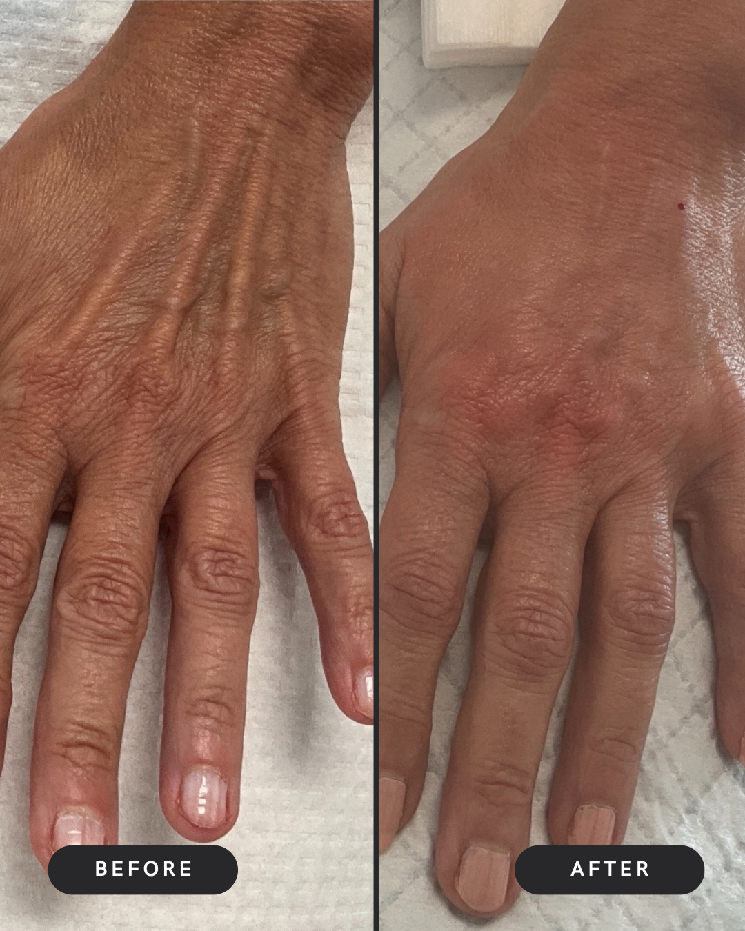 Radiesse For Hands