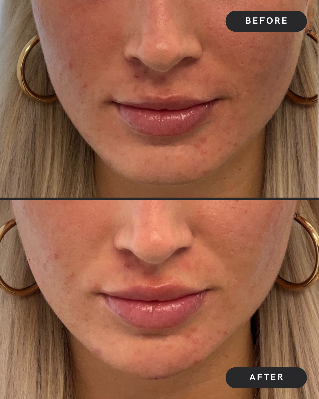 Chin Filler