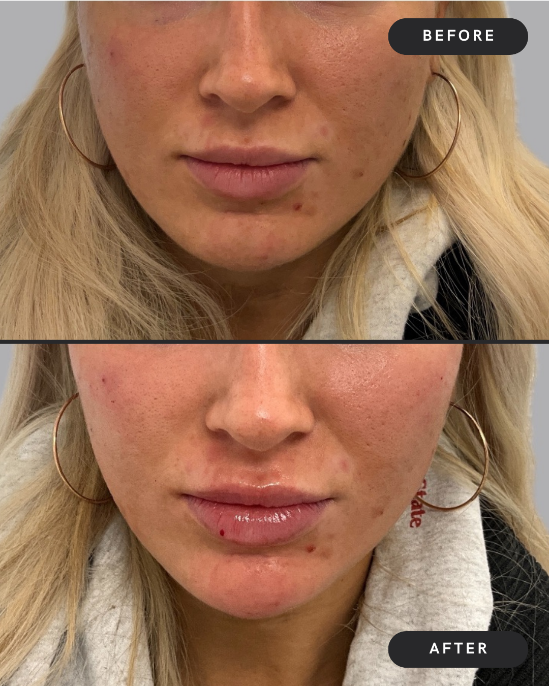 Chin &amp; Cheek Filler