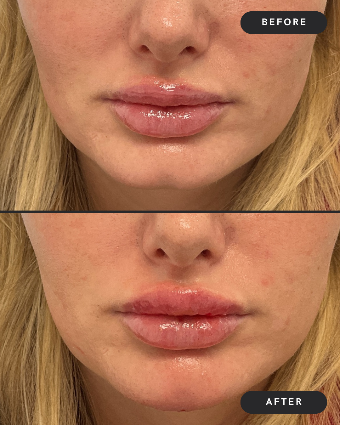 Chin Filler