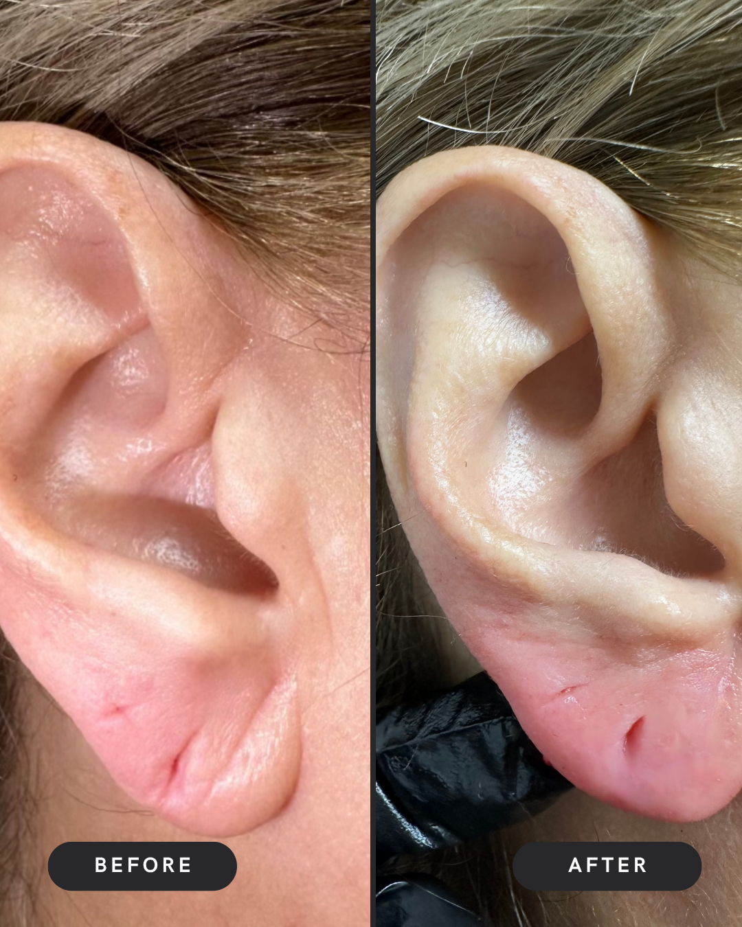 Earlobe Filler
