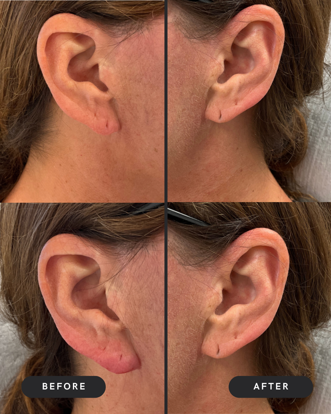 Earlobe Filler