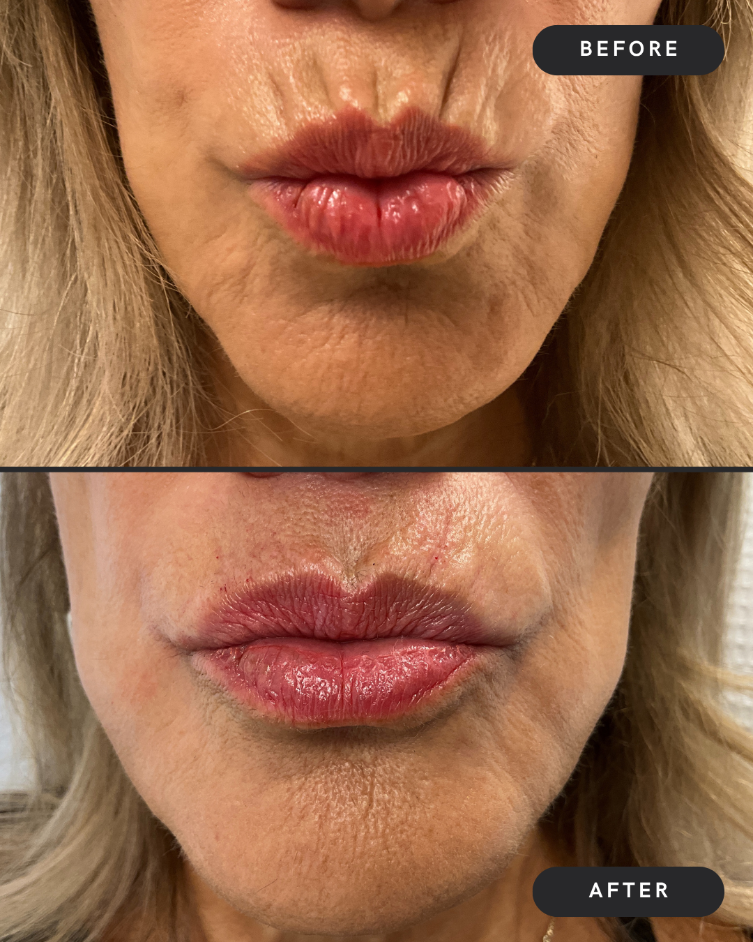 Lip Line Filler