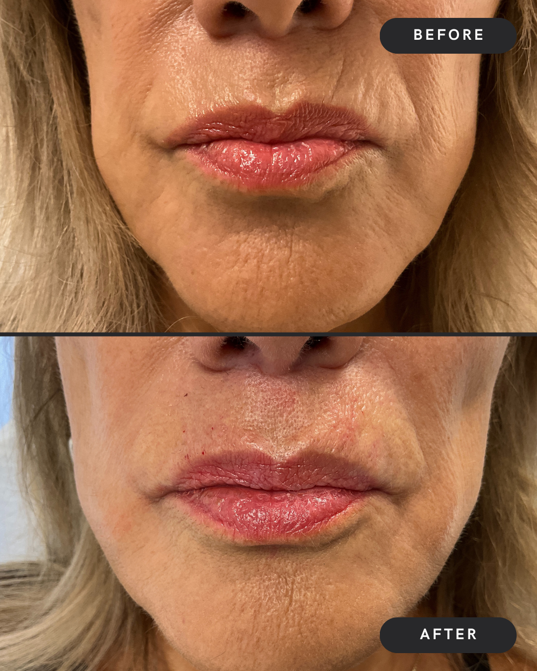 Lip Line Filler
