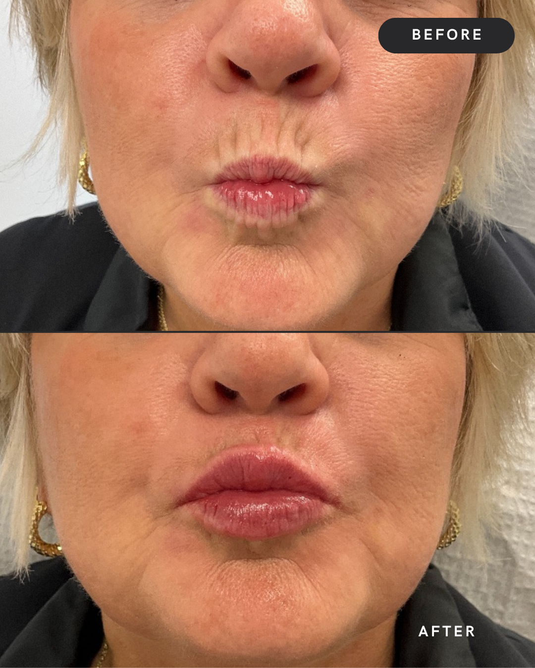Lip Filler