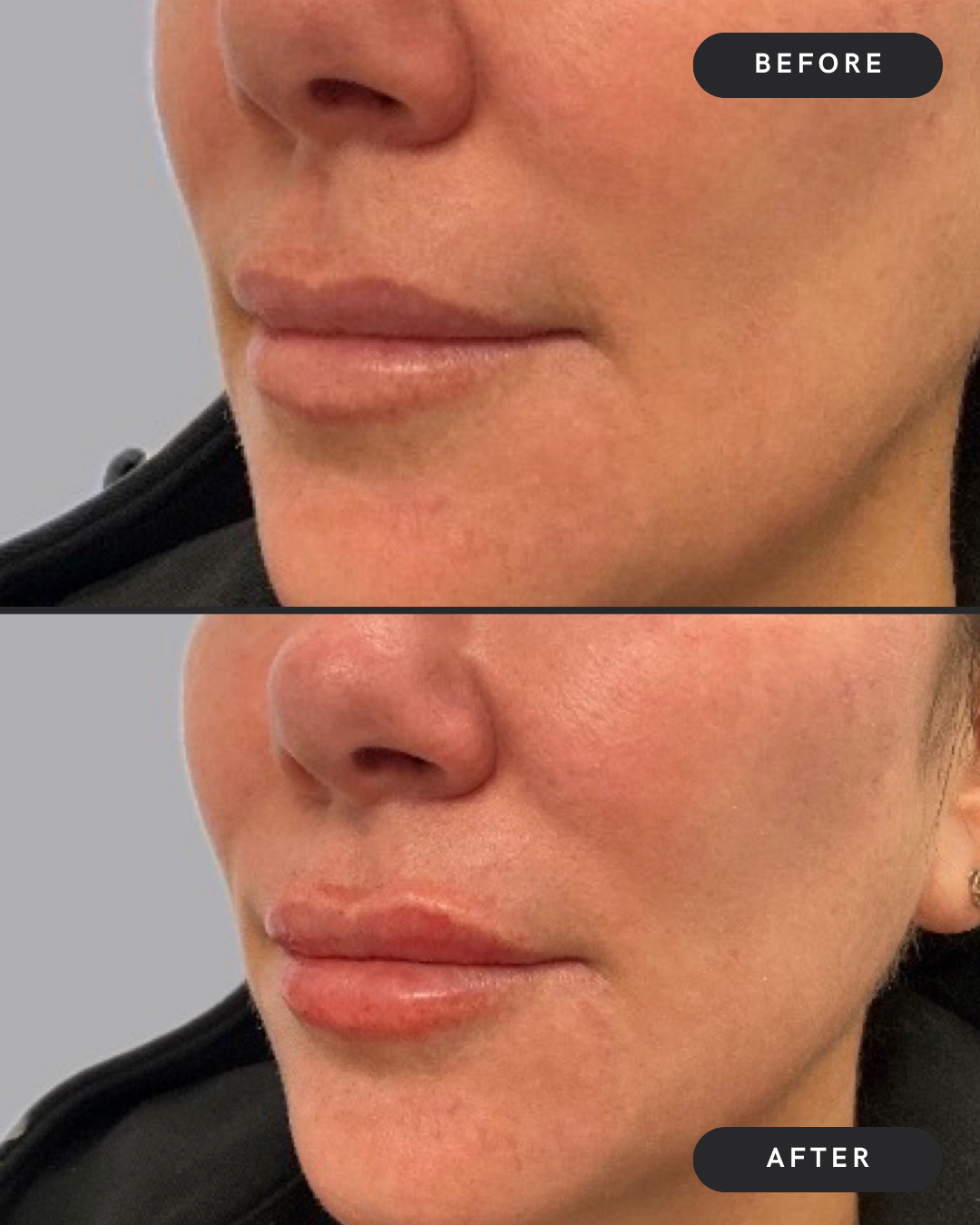 Lip Filler