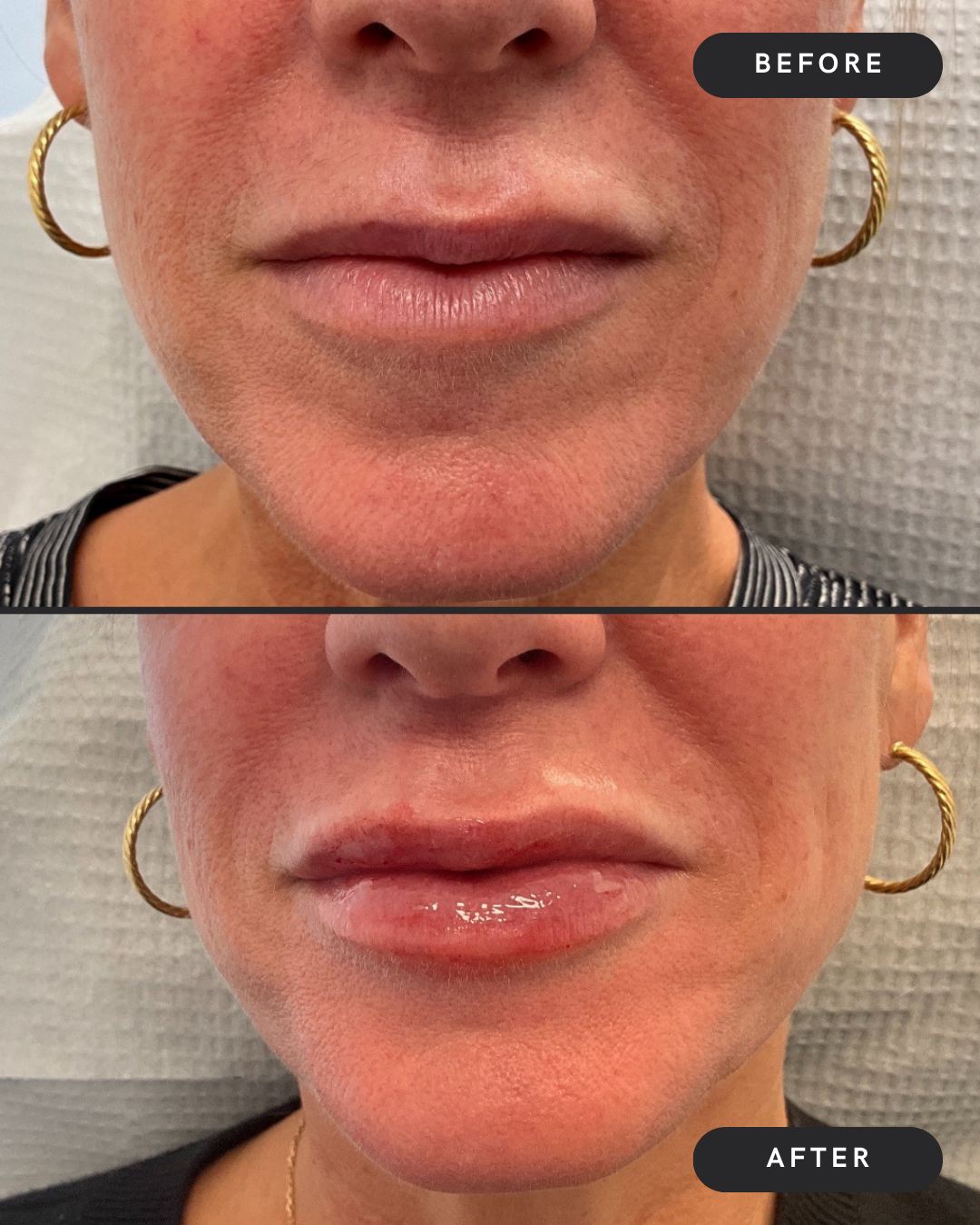 Lip Filler