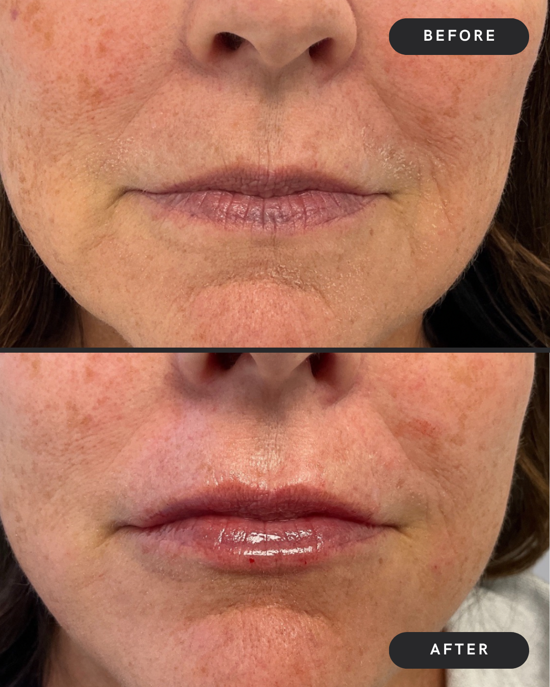 Lip Filler