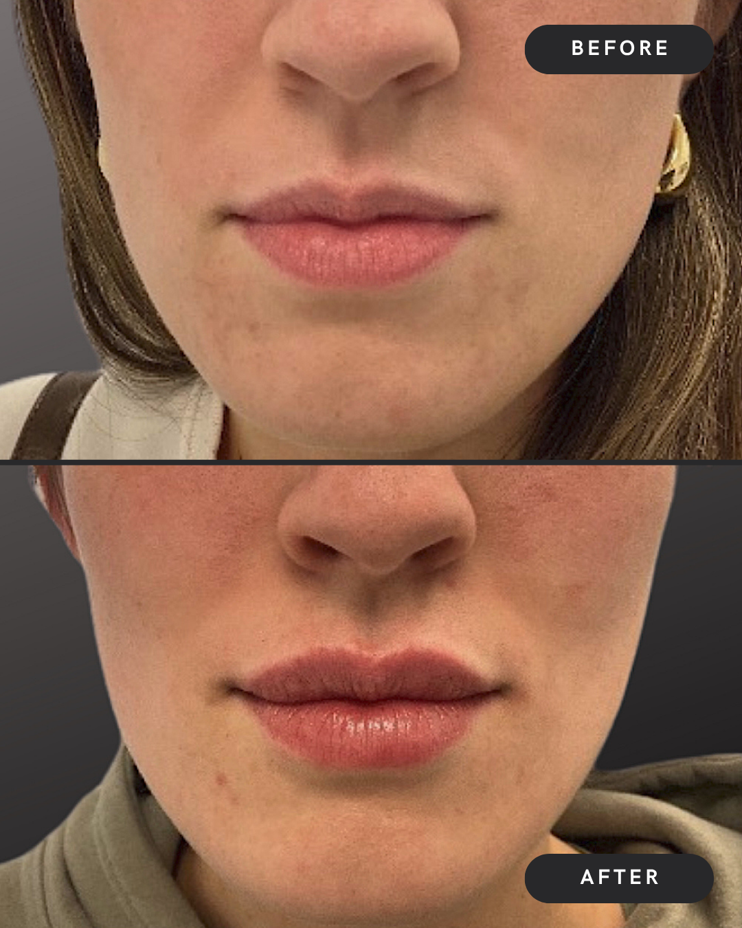 Lip Filler