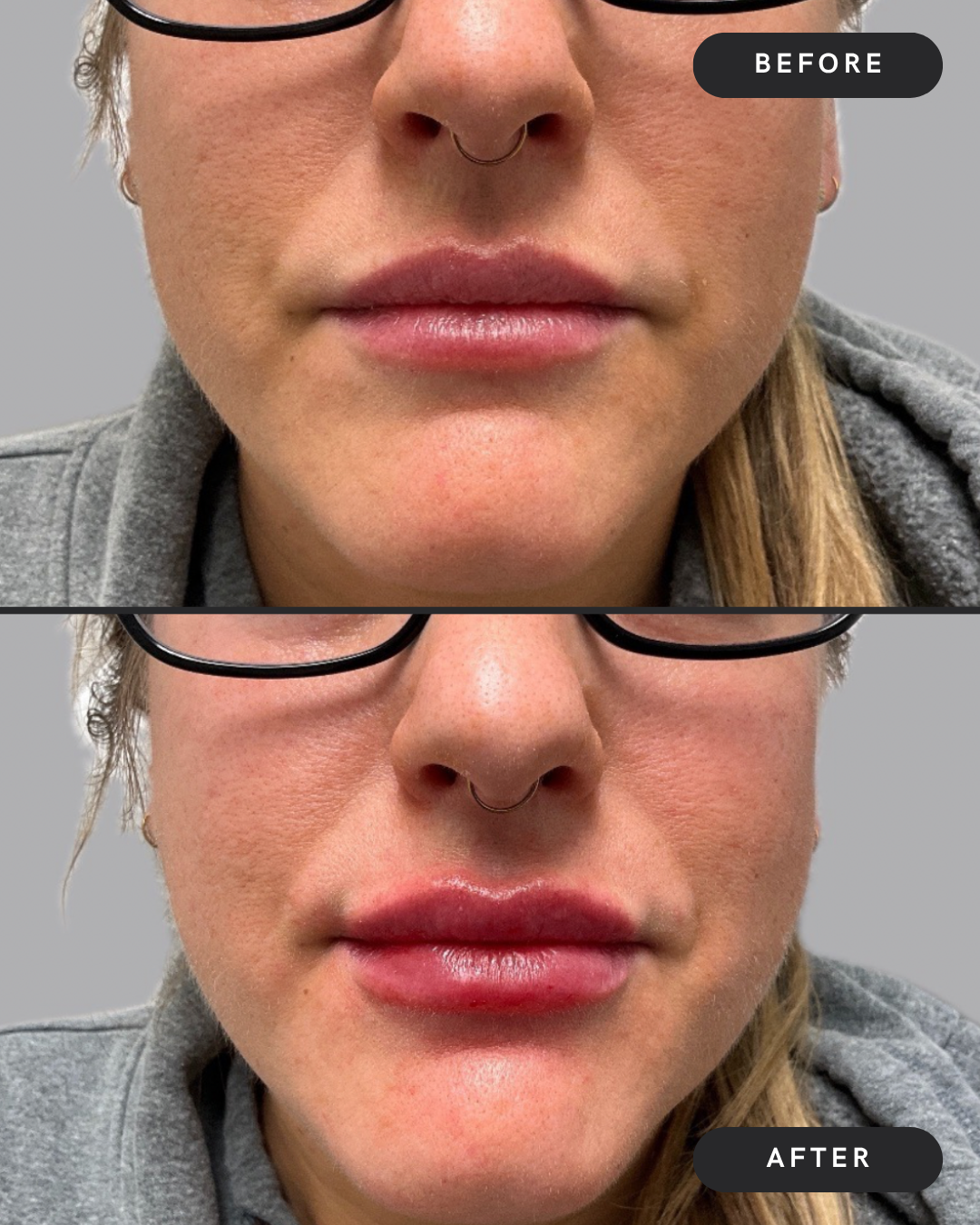 Lip Filler