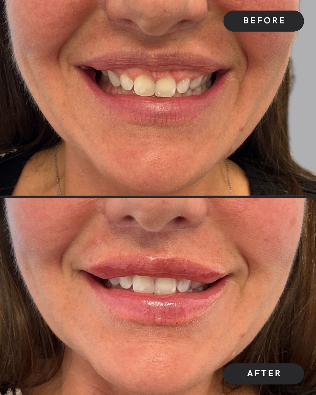 Lip Filler