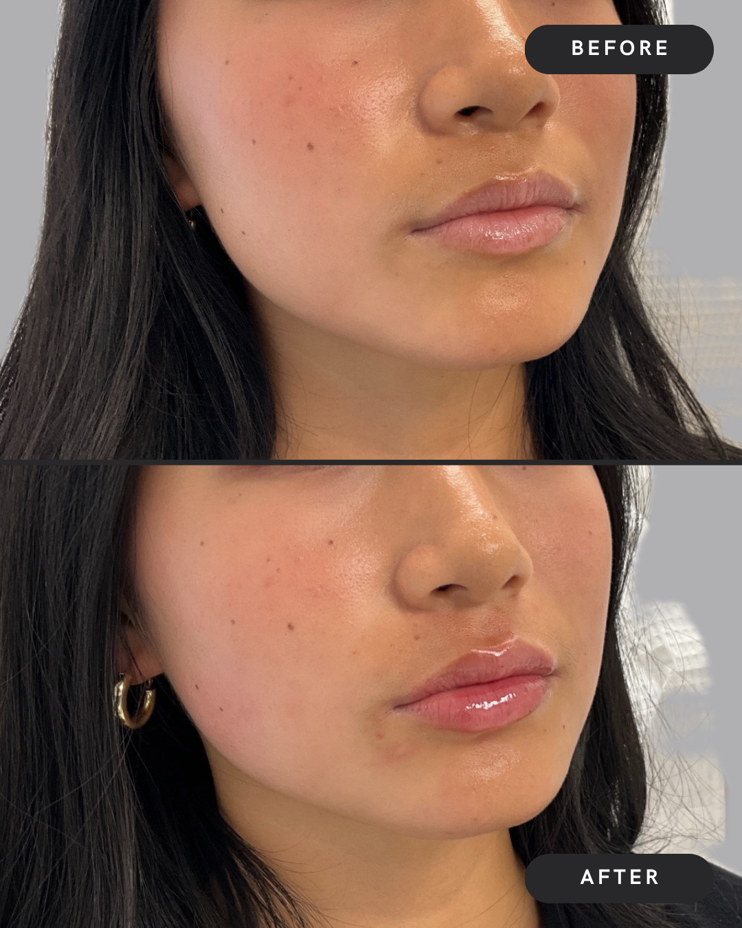 Lip Filler