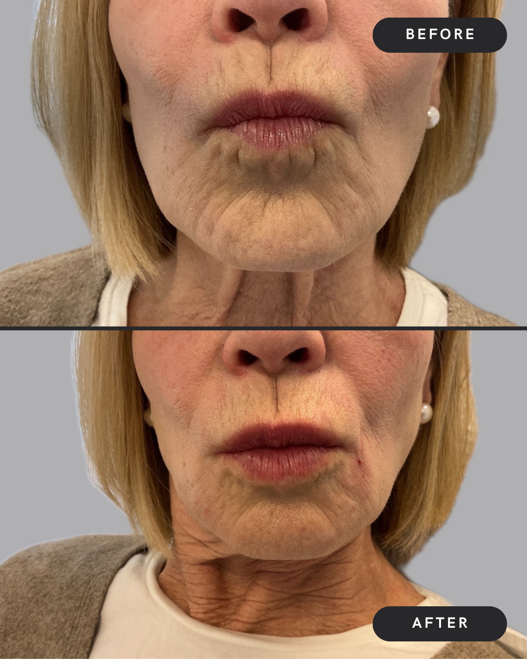 Lip Filler