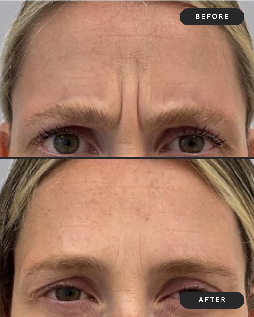 Glabella (11s)
