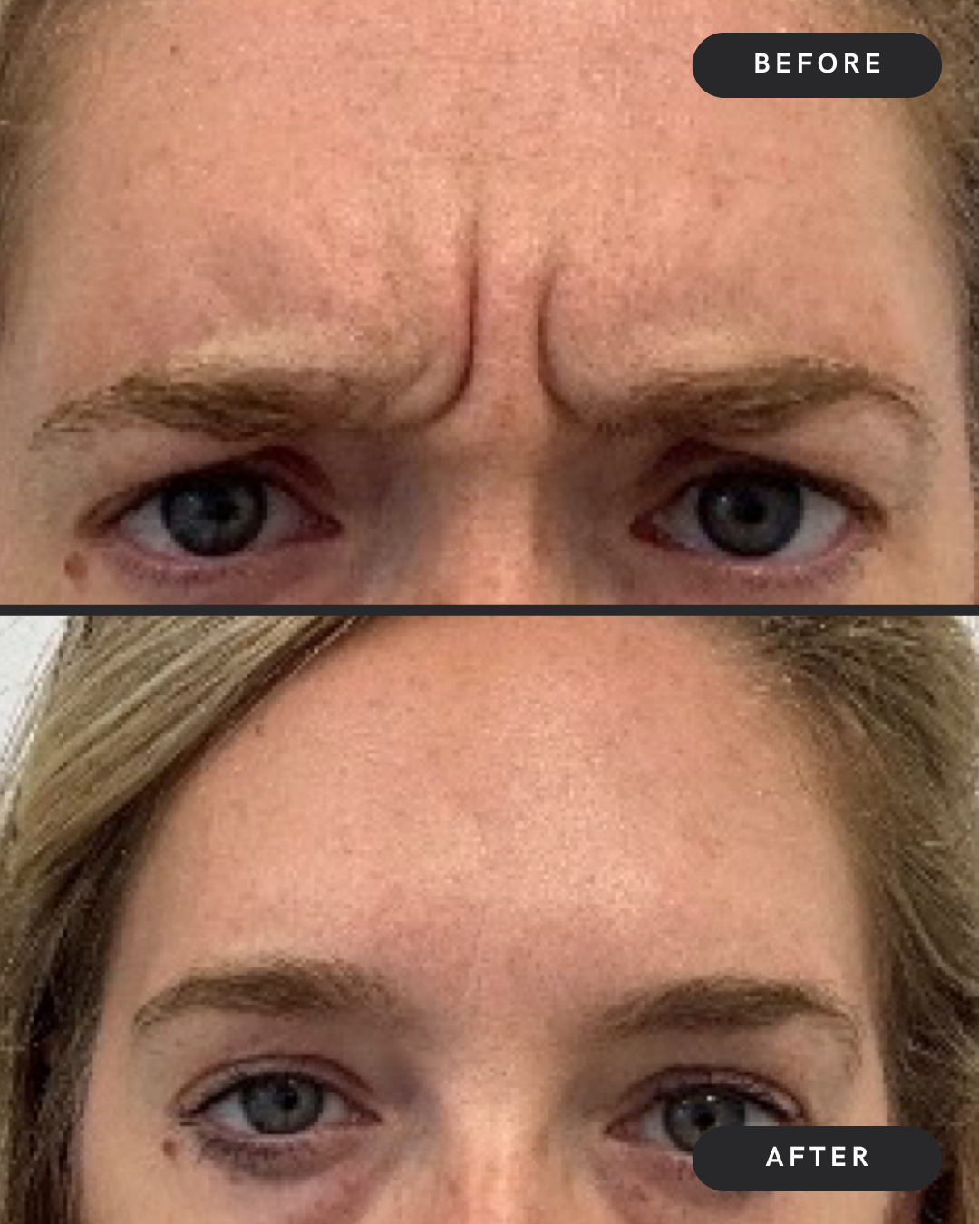 Glabella (11s)