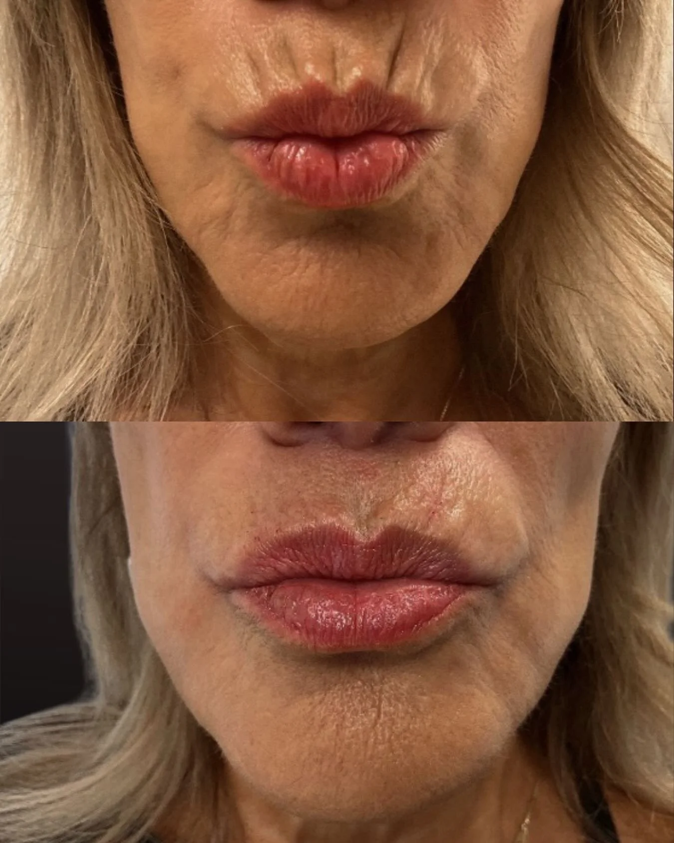 ✨ Softening upper lip lines with a natural, refined result.

Perioral lines (often called upper lip lines or &ldquo;lipstick lines&rdquo;) can develop over time due to repetitive muscle movement, collagen loss, and the natural aging process. With pre