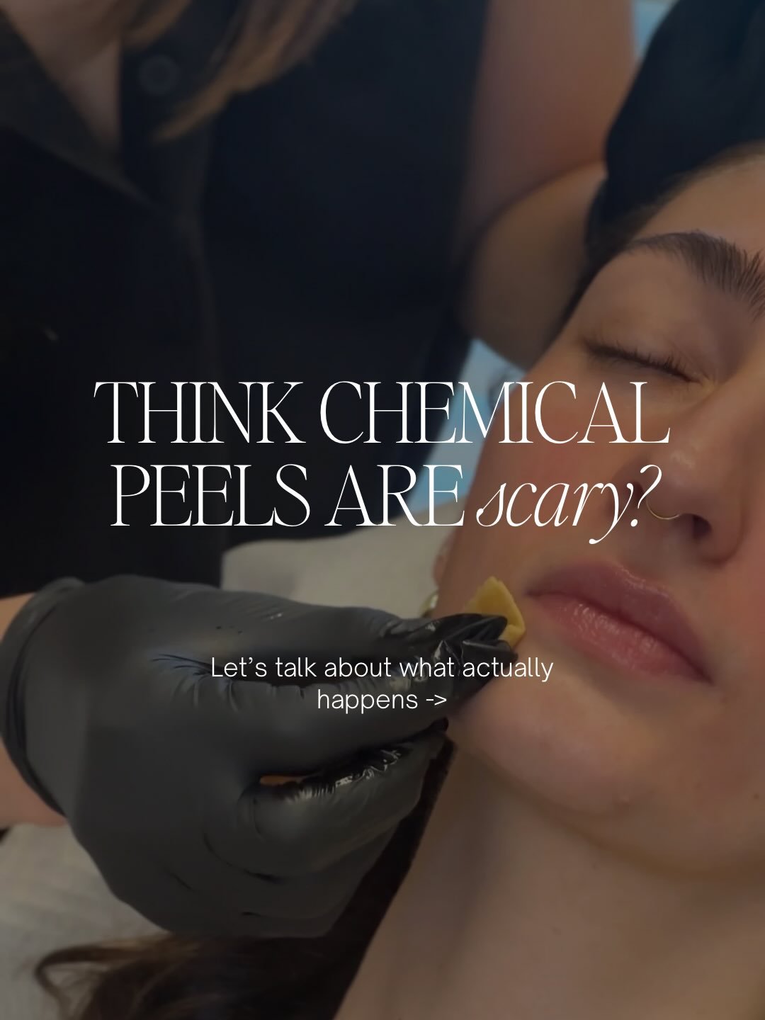 Not all chemical peels are created equal.

A thoughtfully selected peel can improve texture, tone, acne, pigmentation, and overall skin quality - without the fear many people associate with the treatment.

The best results come from proper assessment