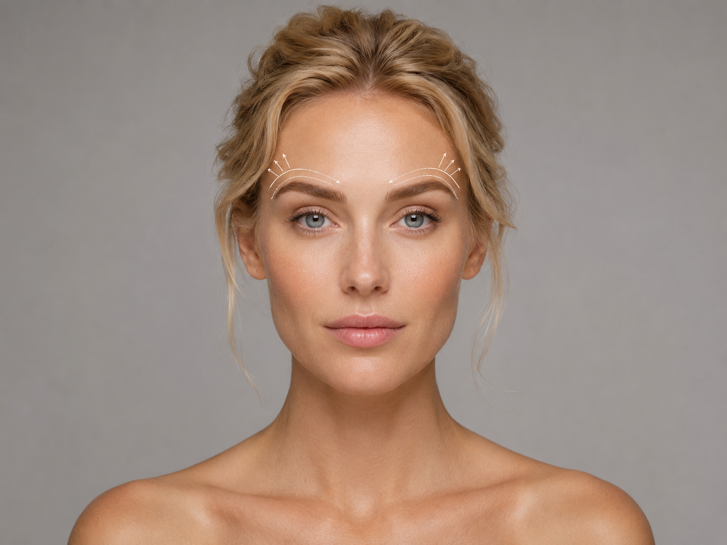 Browlift