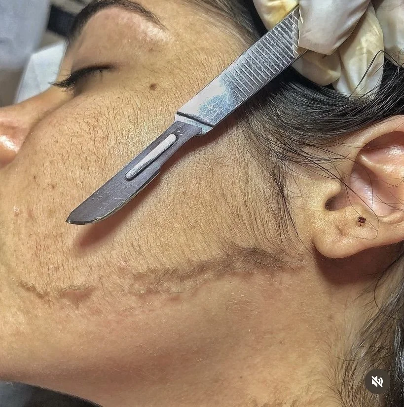 Dermaplane Facial