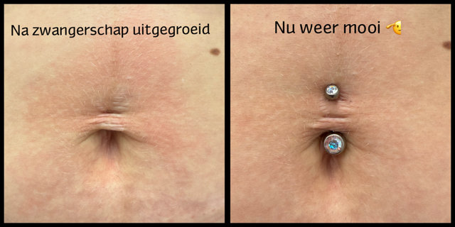 navelpiercing opnieuw.PNG