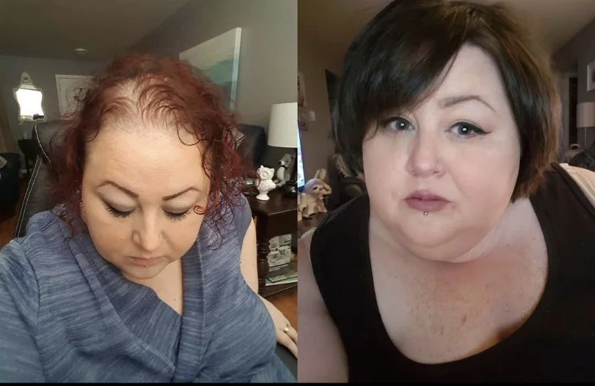 alopecia treatment results