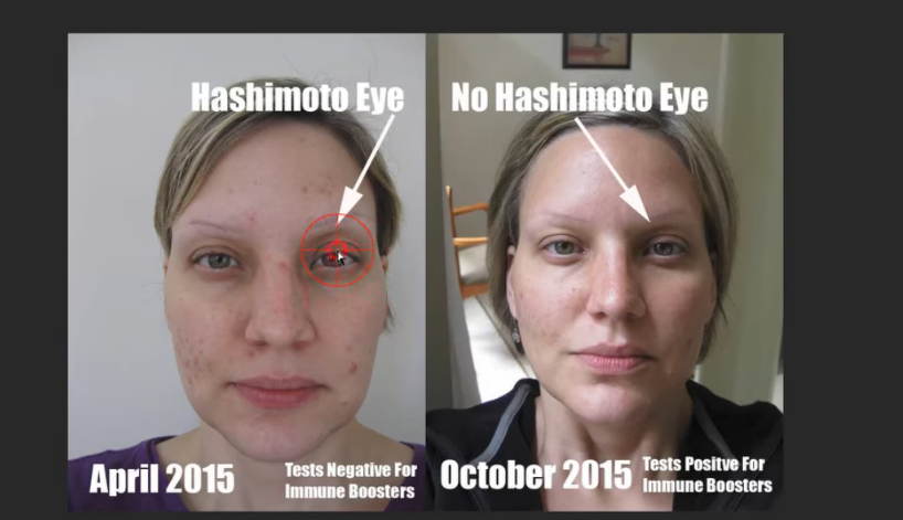 Before and after nutritional deficiency correction showing improvements in facial appearance.