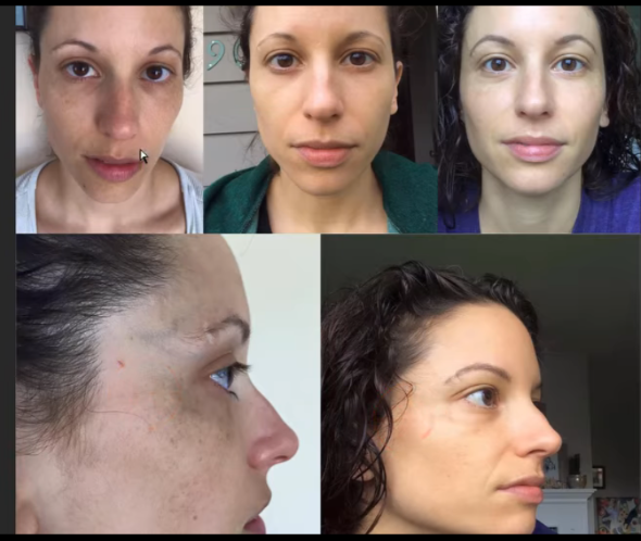 Before and after nutritional deficiency correction showing improvements in facial appearance.