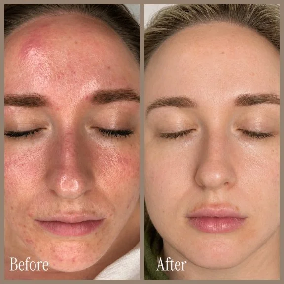 Side-by-side comparison of a woman's face before and after skincare treatment. The 'before' image shows redness, acne, and uneven skin tone. The 'after' image shows clear, smooth, and evenly toned skin.