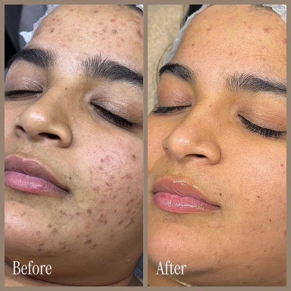 Side-by-side comparison of a woman's face before and after skincare treatment, showing improvements in skin texture and clarity.