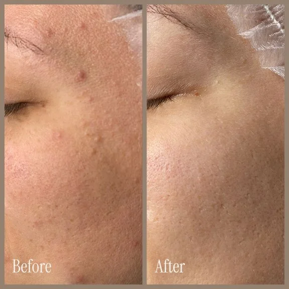 Side-by-side comparison image showing a person's cheek before and after skincare treatment, with visible reduction in acne scars and smoother skin.