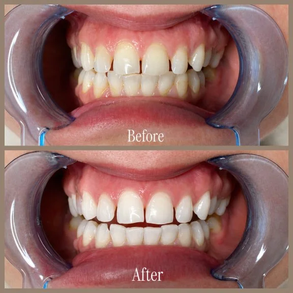 Close-up of a person's teeth before and after dental whitening, showing improvement in tooth color and appearance.