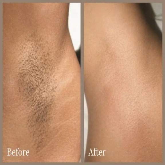 Side-by-side comparison of armpit skin before and after hair removal, showing significant reduction in hair and smoother skin in the after image.