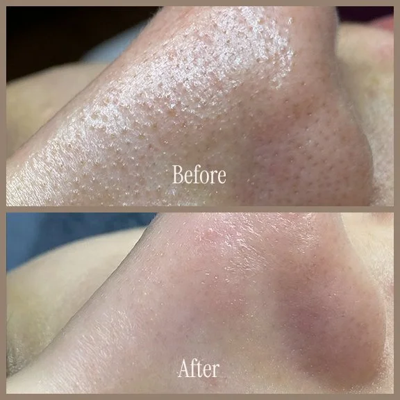 Close-up of a nose showing before and after images of skin treatment, with the before image displaying oily pores and the after image showing clearer skin.