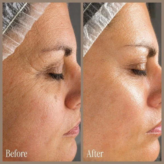 Close-up side profile of a woman's face showing a comparison of skin condition before and after treatment; the left side labeled 'Before' has wrinkles and darker skin, while the right side labeled 'After' shows smoother, clearer skin.
