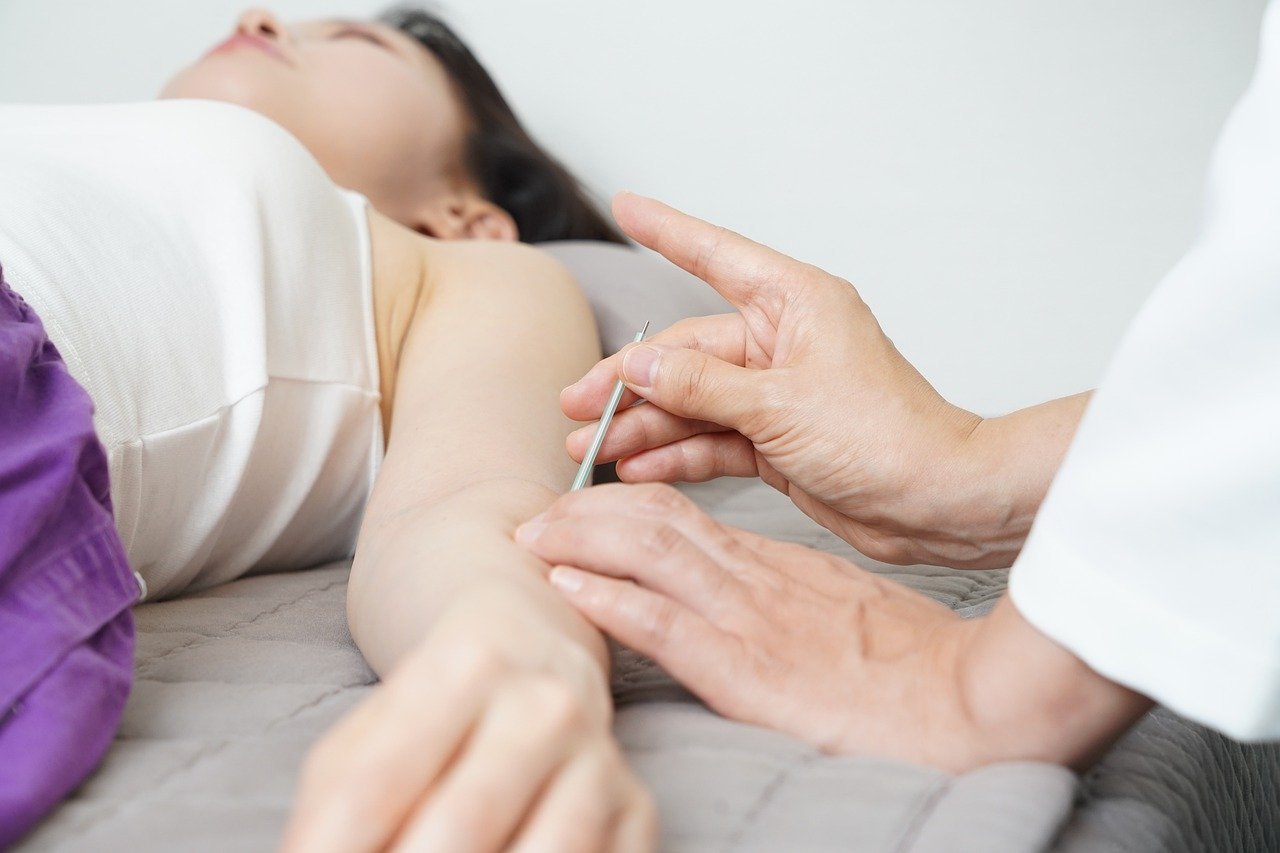 How Acupuncture Helps with Anxiety and Stress in Overland Park