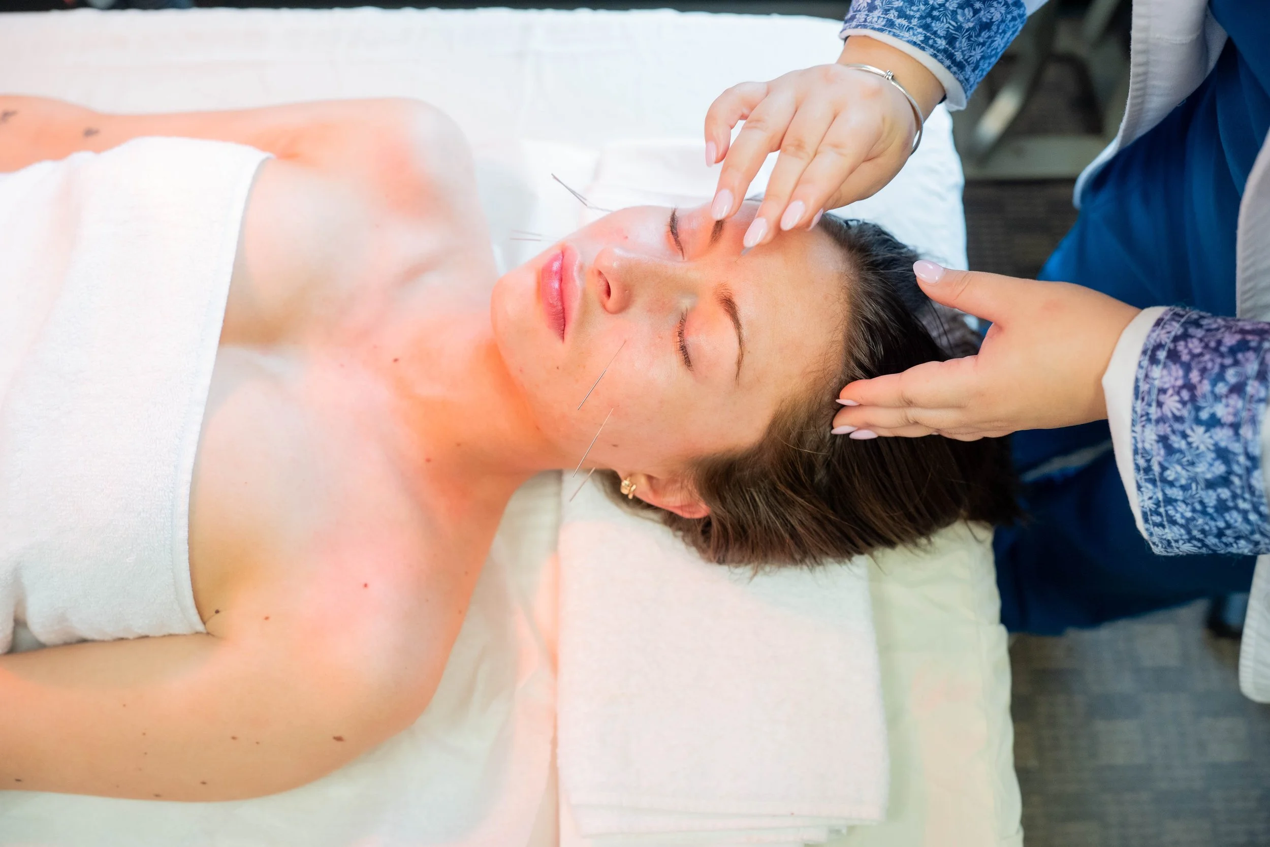 Close-up of a patient receiving facial acupuncture treatment with fine needles applied to the face while lying on a treatment bed in a clinic.