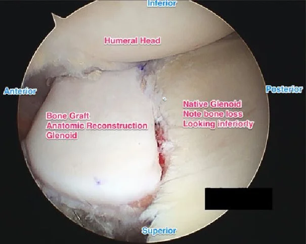 Surgical-technique-of-arthroscopic-anatomic-glenoid-reconstruction_W640.jpg