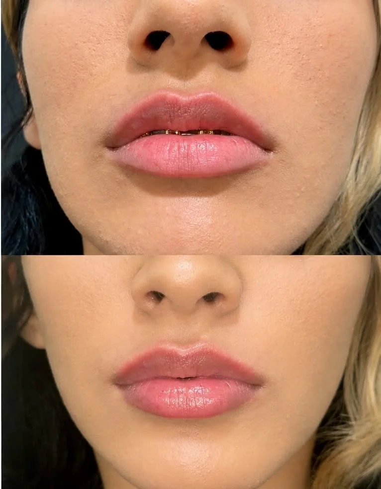 Would you believe this is just one syringe?

✨ Babydoll Lips with Juvederm&reg; ✨

Soft. Balanced. Beautiful.

This stunning transformation was achieved with Juvederm&reg; filler to create naturally fuller, hydrated lips while maintaining a soft, fem