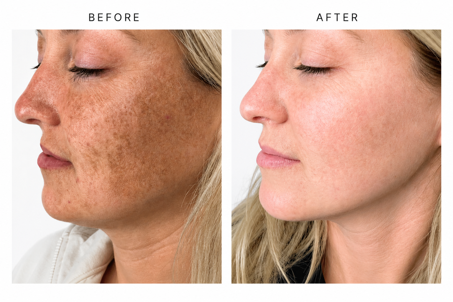 Lumecca IPL Before &amp; After: Remarkable Skin Transformation After 3 Treatments